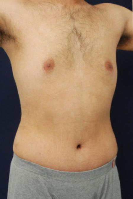 After image 2 Case #102906 - Abdominoplasty