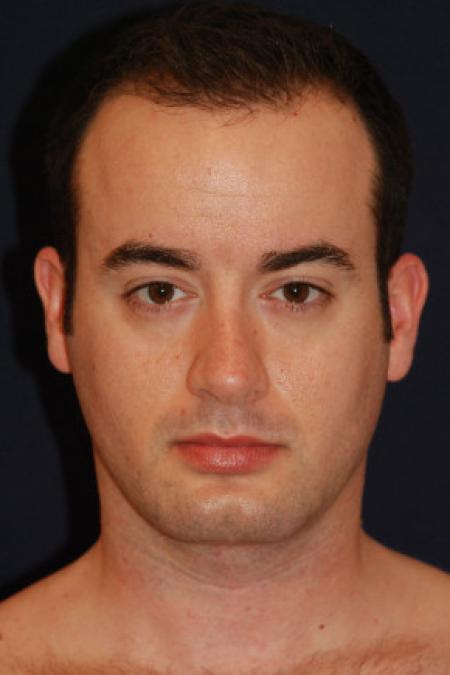 After image 1 Case #102786 - Neck Lift