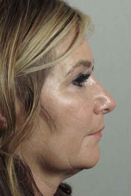 After image 2 Case #103156 - Rhinoplasty Patient 64