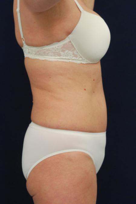 After image 3 Case #102916 - Abdominoplasty