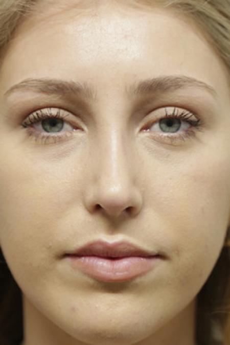 After image 1 Case #103376 - Endonasal Closed ("Scarless") Rhinoplasty