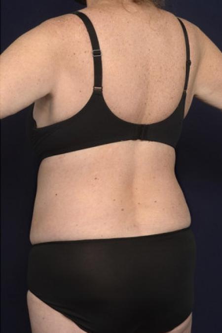 After image 1 Case #102416 - Bra Line Back Lift