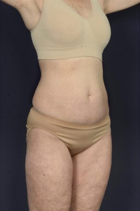 After image 2 Case #102456 - Liposuction