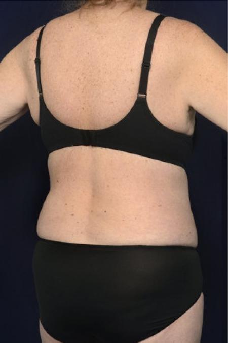 After image 2 Case #102416 - Bra Line Back Lift