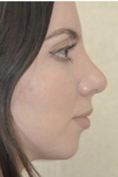 After image 2 Case #103111 - Rhinoplasty