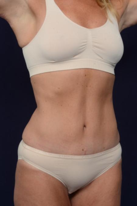 After image 2 Case #102761 - Abdominoplasty