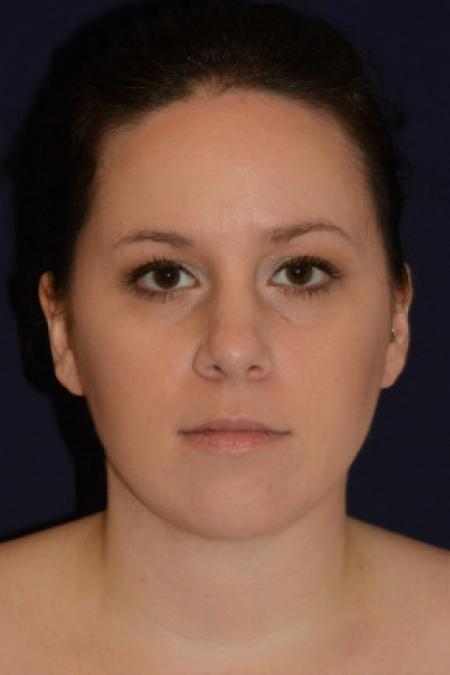 After image 1 Case #102631 - Neck Lift