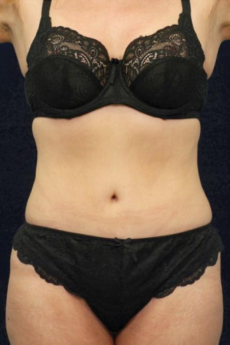 After image 1 Case #102651 - Abdominoplasty