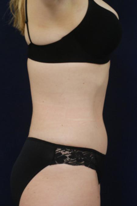 After image 3 Case #102831 - Abdominoplasty