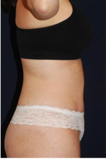After image 3 Case #102856 - Abdominoplasty