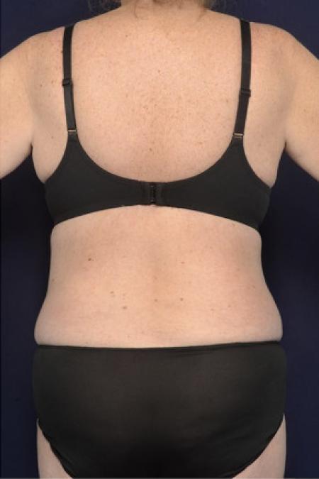 After image 3 Case #102416 - Bra Line Back Lift