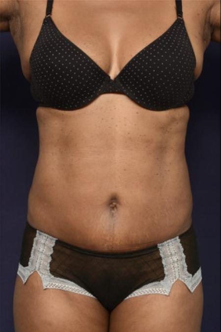 After image 1 Case #102941 - Abdominoplasty