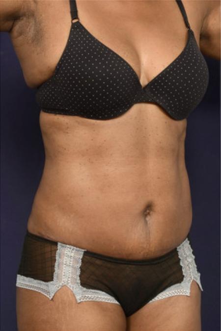 After image 2 Case #102941 - Abdominoplasty