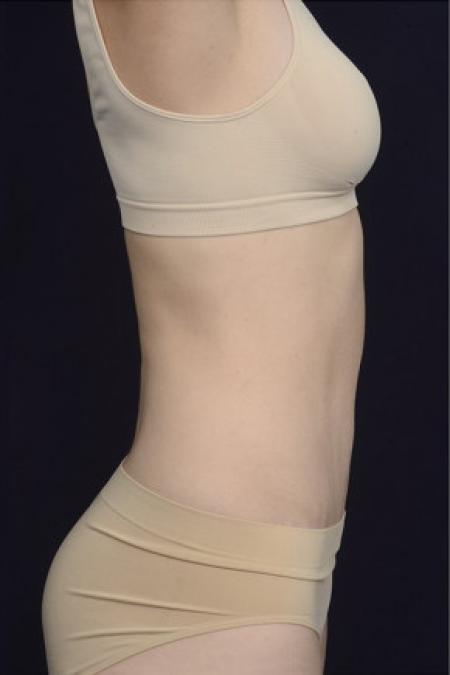After image 3 Case #102951 - Abdominoplasty
