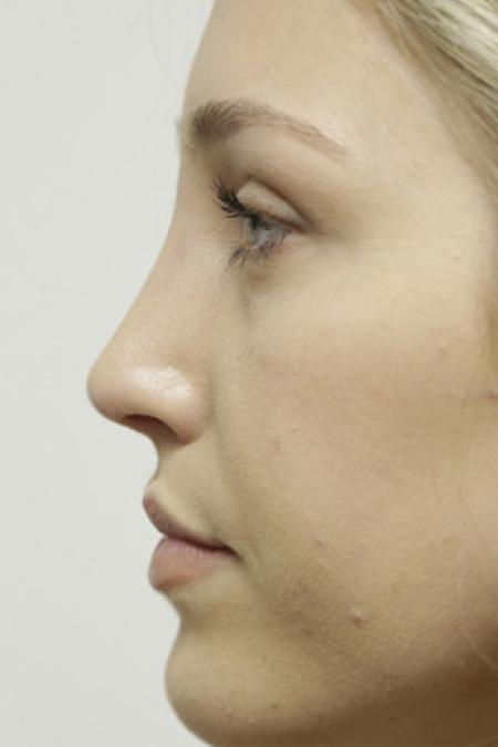 After image 3 Case #103376 - Endonasal Closed ("Scarless") Rhinoplasty