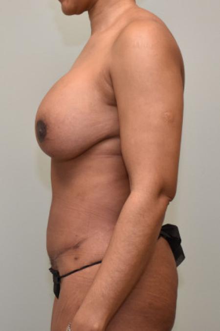 After Case #101606 - Mommy Makeover