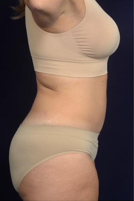 After image 3 Case #102441 - Abdominoplasty