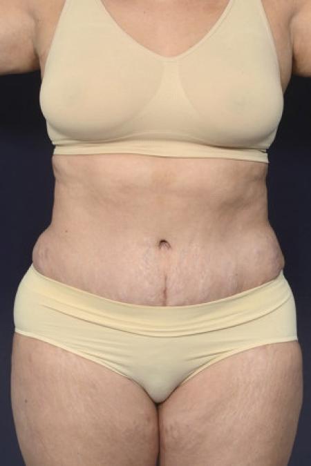 After image 1 Case #102591 - Abdominoplasty