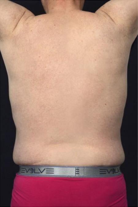 After image 3 Case #102946 - Abdominoplasty
