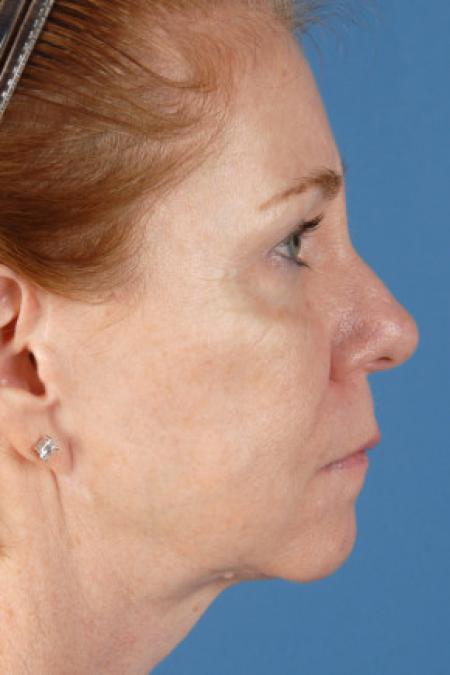 After image 3 Case #102146 - Facelift - 57-year-old woman