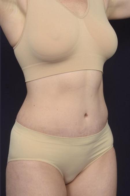 After image 2 Case #102956 - Abdominoplasty