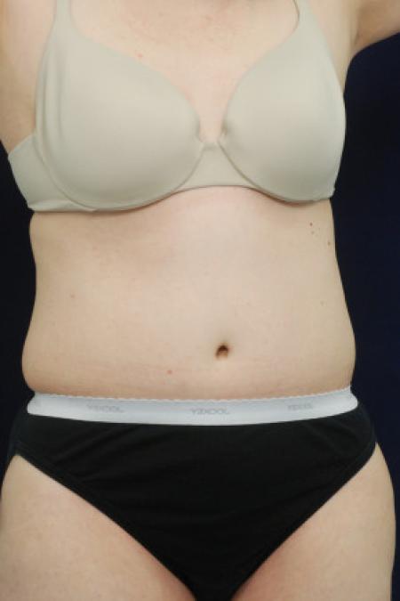 After image 2 Case #102931 - Abdominoplasty