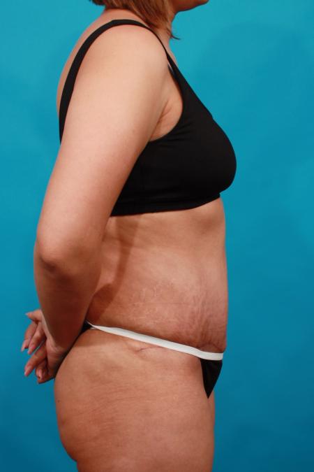 After image 3 Case #104076 - Tummy Tuck