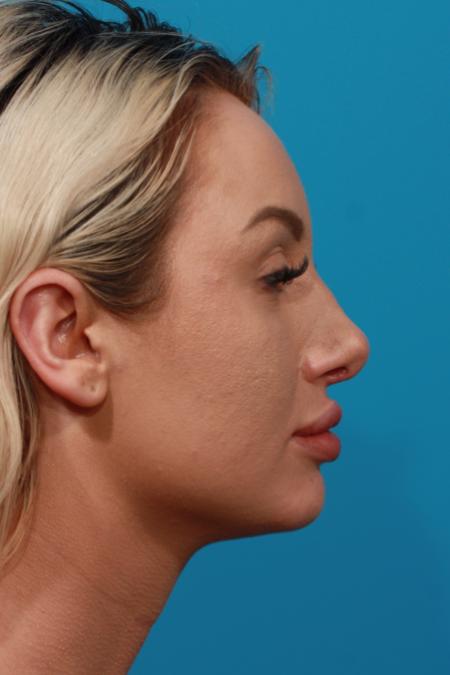 After image 3 Case #104136 - Rhinoplasty