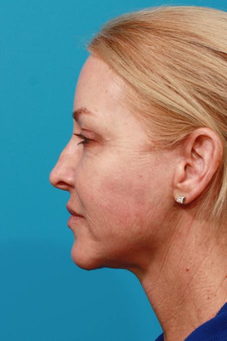 After image 3 Case #103726 - Facelift