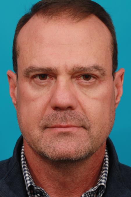 After image 1 Case #104181 - Blepharoplasty