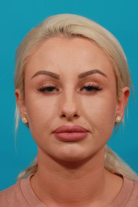 Before image 1 Case #104136 - Rhinoplasty
