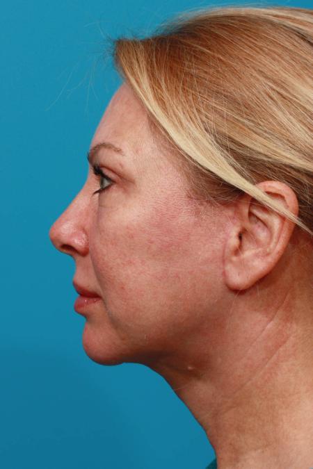 After image 3 Case #103866 - Face Lift