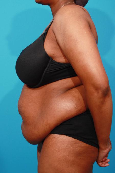 Before image 3 Case #103831 - Tummy Tuck