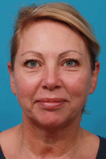 Before image 1 Case #103866 - Face Lift