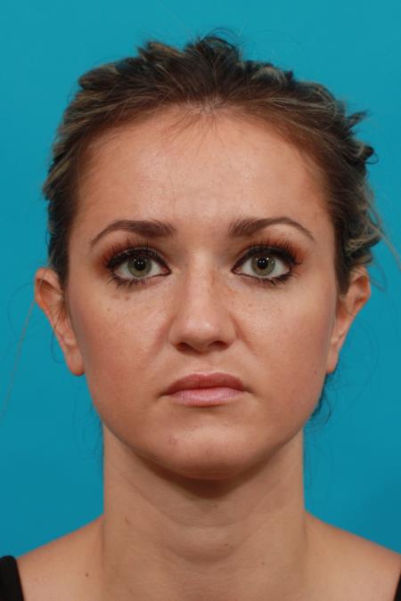 Before image 1 Case #104096 - Rhinoplasty