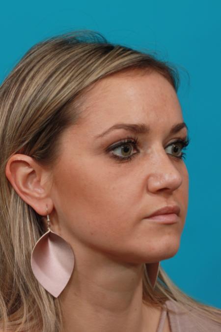 After image 2 Case #104096 - Rhinoplasty