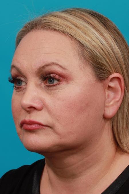 After image 2 Case #103961 - Facial Rejuvenation