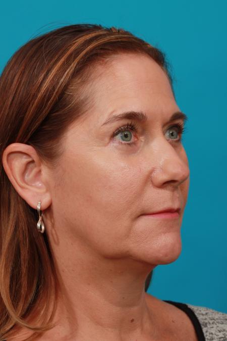 After image 2 Case #104241 - Blepharoplasty