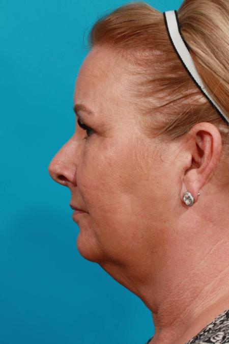 Before image 3 Case #103916 - Face Lift