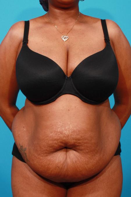 Before image 1 Case #103831 - Tummy Tuck