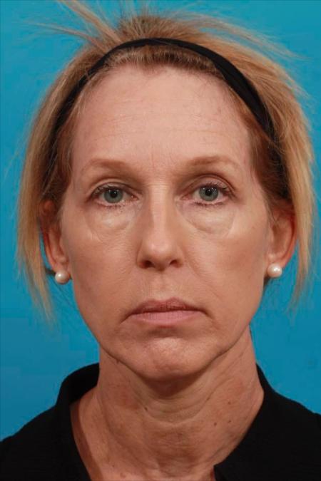Before image 1 Case #104311 - Face Lift