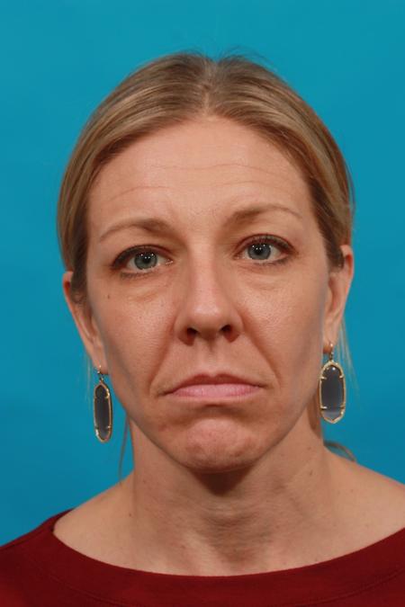 Before image 1 Case #104026 - Blepharoplasty