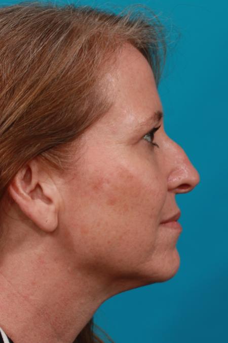 After image 3 Case #104091 - Blepharoplasty