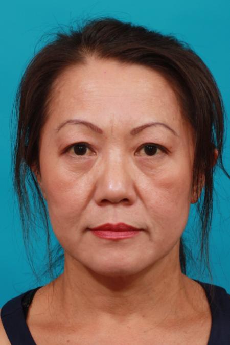 After image 1 Case #104011 - Blepharoplasty