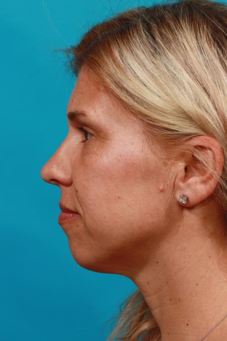 After image 3 Case #104216 - Blepharoplasty
