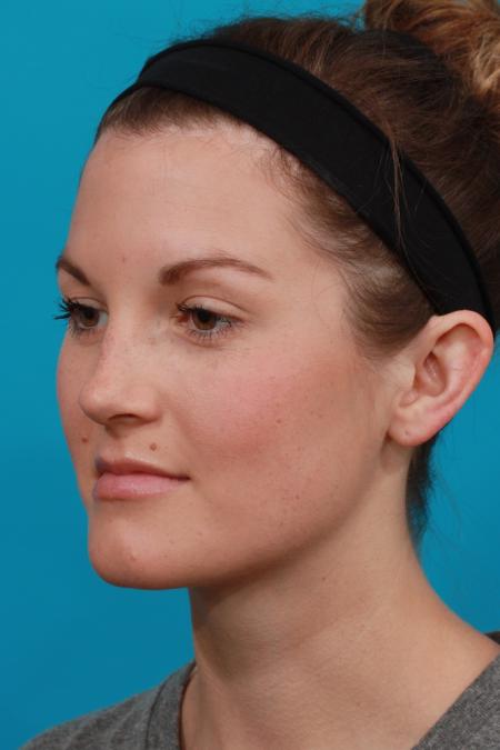 Before image 2 Case #104201 - Otoplasty