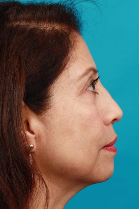 After image 3 Case #104381 - Blepharoplasty