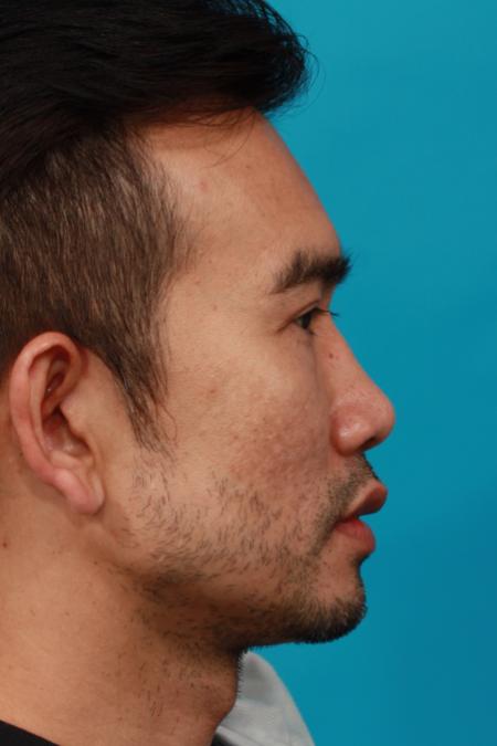After image 3 Case #104131 - Eyelid Surgery