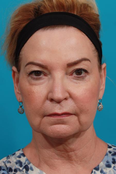 Before image 1 Case #104031 - Face Lift