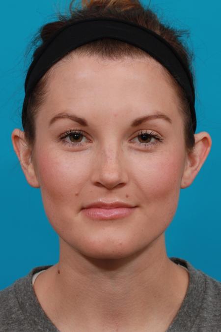 Before image 1 Case #104201 - Otoplasty